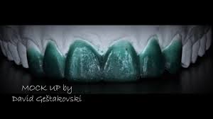 Mock Up Veneers Youtube