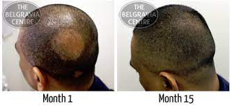 Besides alopecia areata, corticosteroid shots can be used for traction alopecia, and several types of inflammatory hair loss like ccca and discoid lupus, among others. Treatment For Alopecia Areata