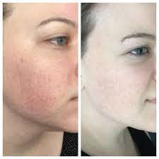 I wash and tone my face, use the soolantra and wait. Oracea
