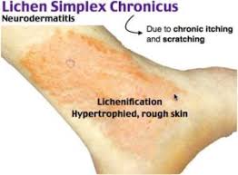 Image result for Lichen Simplex Chronicus