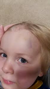 Husband finds cool bandages for child