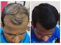 Our hair loss treatment & hair transplant clinic located in gurgaon delhi ncr is easily accessible. Meet India S Hair Growth Queen Dr Stuti Khare Shukla Times Of India