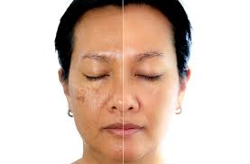 Fotona Liplase: The Natural Alternative to Lip Fillers