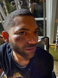 Así de ABIMBAO QUEDO Alexander Ortiz paredes DESPUES DEL ABUSO POLICIAL EN  VERAGUA Y EL ALCALDE Luis Canela SIGUE MUDO.