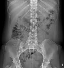This includes the stomach, liver, spleen, and large and small intestines. Radiology Masterclass Abdominal X Ray Quiz 2 Question 6 Patient With Acute Abdominal Pain What Does The X Ray Show A Caecal Volvulus B Normal Appearances C Pneumoperitoneum D