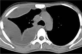 May 25, 2021 · the aetiology of the pleural effusion determines other signs and symptoms. Pleural Effusion Diagnosis Treatment And Management Abstract Europe Pmc