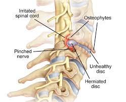 It allows the upper limb to have a wide array of movements. Cervical Radiculopathy Causes Symptoms And Treatment