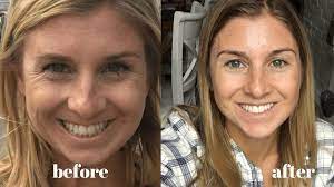 If you are taking collagen or planning on adding collagen supplements to your routine, you might be wondering how long it takes for collagen to start working. Vital Proteins Review Before And After Picture Too