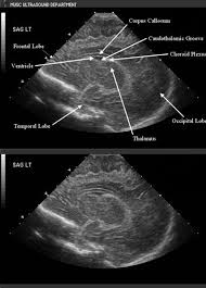 Cranial Ultrasound Sagittal View Ultrasound Technician Ultrasound Sonography Medical Ultrasound