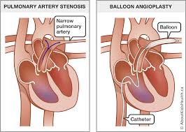 Angioplasty is a procedure used to open blocked coronary arteries caused by coronary artery disease. Pulmonary Artery Stenosis Balloon Angioplasty In The Heart Catheterization Lab