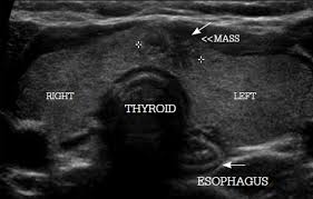 Although a number of disorders may result in hyperthyroidism, graves' disease is a common cause. Racgp Goitre Causes Investigation And Management