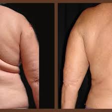 Image result for Liposuction