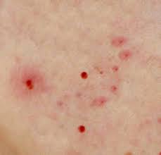 Image result for mite bites on humans