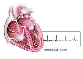 Image result for Atrial Fibrillation