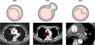 Image result for Aortic Dissection