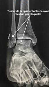 La cheville est composée d'un ensemble de ligaments, de tendons et d'os, unit le pied au squelette de la jambe, et joue un rôle essentiel dans la mobilité puisqu'elle permet le déroulement des pas lors de la marche. Icpr Lesions Ligamentaires De La Cheville