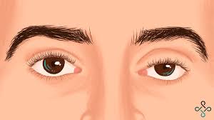 Spotlight On Myasthenia Gravis Mg Autoimmune Connect
