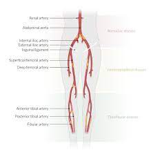 Peripheral Arterial Disease Amboss