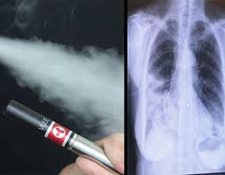 It's sometimes caused by breathing in a chemical used to flavor microwave popcorn. Medical Professional Links Popcorn Lung Disease To Vaping Montgomery Community Media