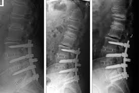 Prof Dr Christian Woiciechowsky Neurochirurgie Berlin Schraubenlockerung