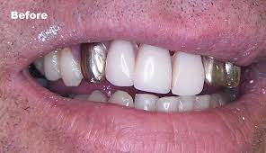 Instead, dental gold is mainly comprised of an average of 16k gold alloy, which includes palladium, copper, silver, or tin. Gold Tooth Gold Tooth Cap Gold Crown Tooth Gold Teeth Caps Front Teeth Br Deva Dental Clinic