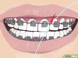 How to floss with braces and how to floss with a retainer. 4 Ways To Floss With Braces Wikihow