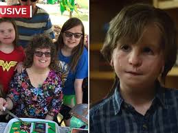 The real-life Wonder: Living with Crouzon Syndrome