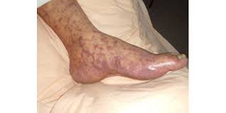 Symptoms of rocky mountain spotted fever in dogs. Signs And Symptoms Rocky Mountain Spotted Fever Rmsf Cdc