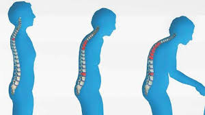 Ini adalah tanda pertama dari tuhan ketika ini juga mata hitam kita tidak akan bersinar lagi dan bagi orang yang sakit hidungnya akan 9. 7 Tanda Gejala Osteoporosis Health Liputan6 Com