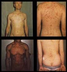 Image result for Secondary Syphilis