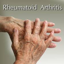 Rheumatoid Arthritis Reasons Why Fir Gloves Help Ra Sufferers Therapygloves Com