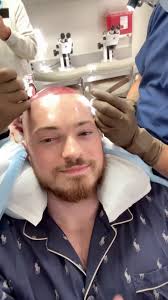 6 Month Hair Transformation 😱 Huge thanks to @la.fue.hair.clinic for doing  gods work 🔥🙌🏻