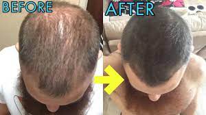 Does microneedling work for hair loss? Crazy Micro Needling Before After Results For Hair Regrowth Youtube