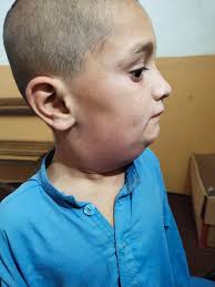 7 years old child presented to my clinic with the following symptoms so  what is your Dx but I know the tx 😊