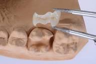 Dental Inlays and Onlays Phoenix AZ - Choules Family Dentistry