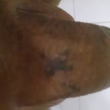 The burns will affect the skin, not the hair follicle, due to the excess of laser energy applied during the treatment. I Got These Burns After A Laser Hair Removal Treatment Are They Permanent Photo