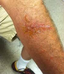 Image result for Rhus Dermatitis