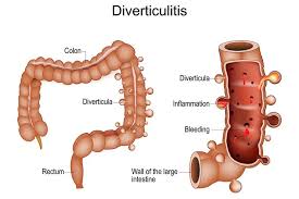 Image result for Diverticulitis