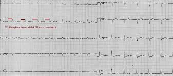 Atrioventricular (av) block occurs when the atrial depolarization fail to reach the ventricles or when atrial depolarization is conducted with a delay. Interpretarea TulburÄƒrilor De Conducere Ale Inimii Pe Ekg NoÈ›iuni De Fiziopatologie Pentru StudenÈ›i Newsmed Ro