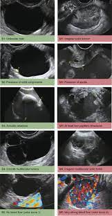 Benign pelvic/ovarian masses occur with almost equal frequency before and after menopause. Ultrasound Imaging In Ovarian Masses Benign Or Malignant Chapter 21 Ultrasonography In Gynecology