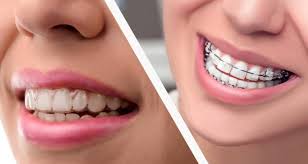 Straighter Teeth But A More Crooked Smile Now? : R/Invisalign