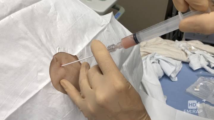 PLEURAL TAPPING product image