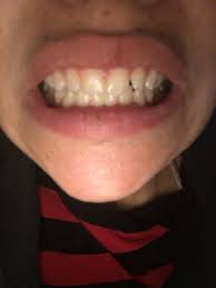 How long do braces take to straighten one tooth. Can My One Crooked Tooth Be Fixed With A Retainer Photos