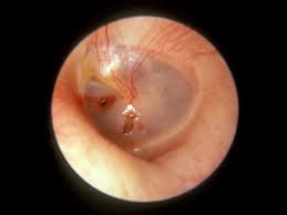 The eardrum, also known as the tympanic membrane, is a thin layer of tissue that separates the outer ear from the middle ear. Ruptured Eardrum Perforated Eardrum Hla Medical