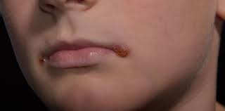 Ein lippenpeeling pflegt trockene lippen im nu samtig weich. Lippenentzundung Hausmittel Und Arztliche Hilfe Herold