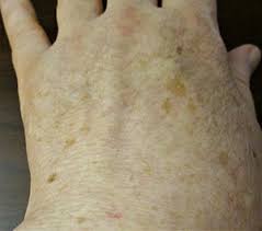 Having a blister on your hand is annoyingly painful. Liver Spot Wikipedia