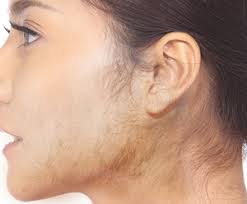 In case you're new here (welcome!), hair wellness is based on the science that hair growth goes far beyond the scalp. Hirsutism Treatment London Uk Abnormal Hair Growth Harrow Northwood