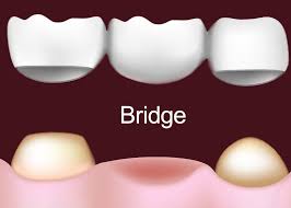 Check spelling or type a new query. Dental Bridge Dentist Orem Utah Crawford Leishman Dental