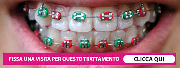 Molte persone che hanno bisogno degli apparecchi. Ortodonzia Fissa O Mobile Studio Dentistico Carpegna Dentista Torino