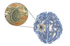 Spanish Researchers Associated Fungi In The Brain With Als